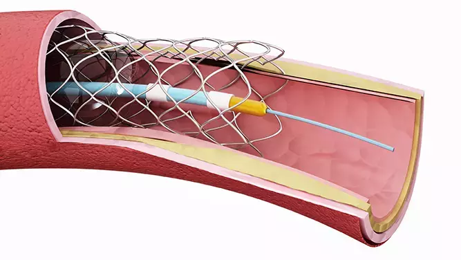 Pressure Sensing for Angioplasty - Figure 2